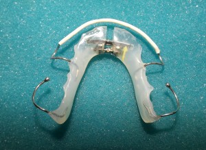 Placca ortodontica dopo trattamento Splendente