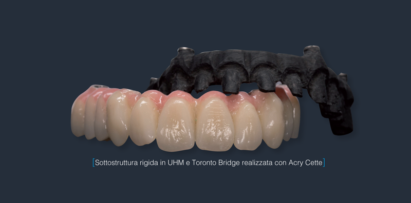 Le applicazioni della fibra di carbonio in campo dentale e le fasi lavorative per la realizzazione di una Toronto Bridge