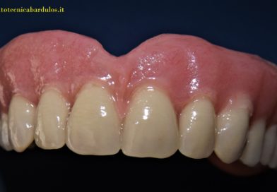PROTESI TOTALE A SUPPORTO OSTEO-MUCOSO : INDICAZIONI E SUGGERIMENTI PER L’USO